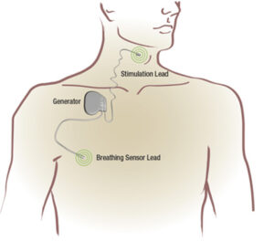 pasha diagram hypoglossal nerve stimulation